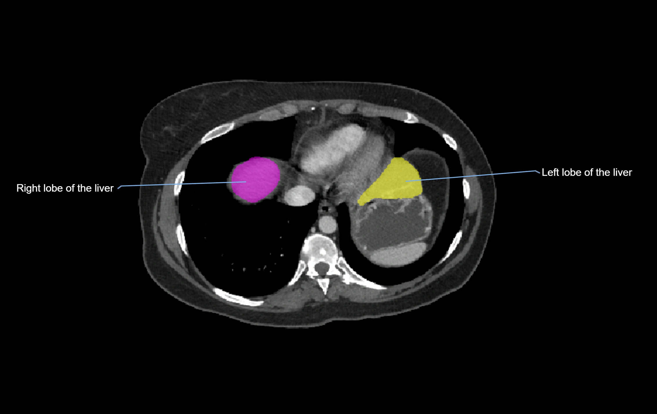 CT lliver lobes axial cross sectional anatomy labelled image -00074.webp